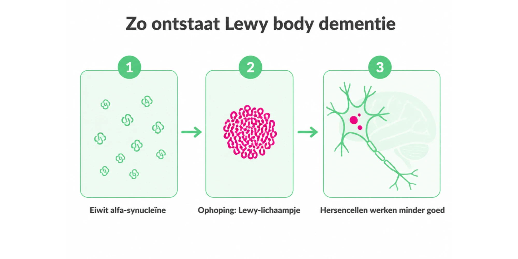 Illustratie: het eiwit alfa-synucleïne hoopt zich op in hersencellen. Die ophopingen heten Lewy-lichaampjes en veroorzaken Lewy body dementie.